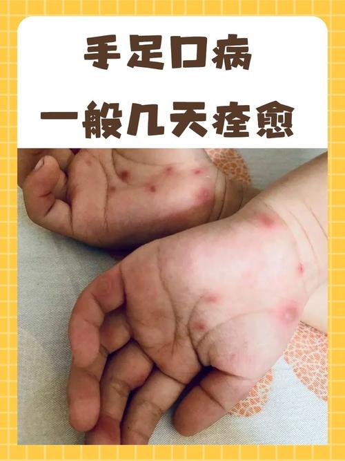 【水痘聚集性疫情定义,水痘是密集的吗】-第4张图片 【水痘聚集性疫情定义,水痘是密集的吗】-第4张图片