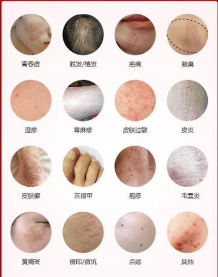 水痘聚集性疫情定义-水痘聚集性疫情基本标准是多少例-第4张图片 水痘聚集性疫情定义-水痘聚集性疫情基本标准是多少例-第4张图片