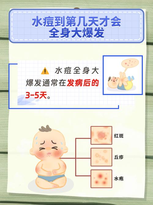 水痘聚集性疫情定义-水痘聚集性疫情基本标准是多少例-第6张图片 水痘聚集性疫情定义-水痘聚集性疫情基本标准是多少例-第6张图片