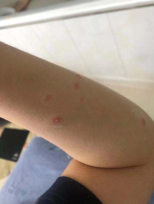 水痘聚集性疫情定义-水痘聚集性疫情基本标准是多少例-第7张图片 水痘聚集性疫情定义-水痘聚集性疫情基本标准是多少例-第7张图片